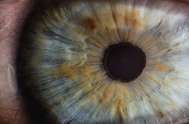 Laser vision correction