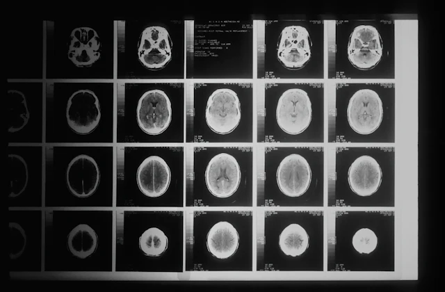 PET-CT scan