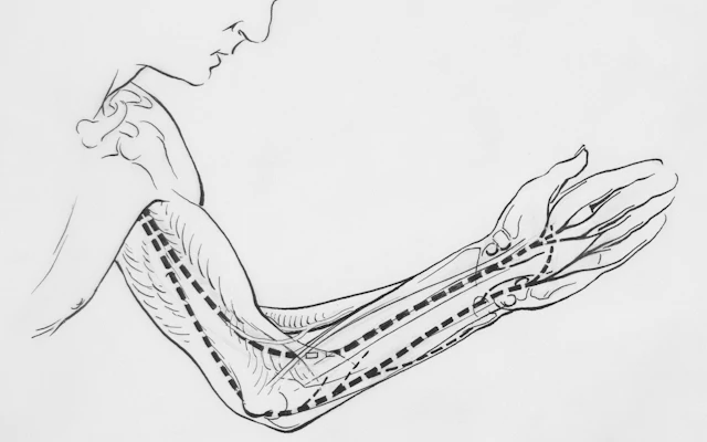 Tennis elbow (epicondylitis)