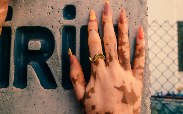 Vitiligo