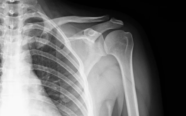 Shoulder pain